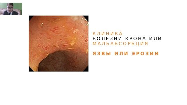 Терминальный илеит: всегда ли болезнь Крона?