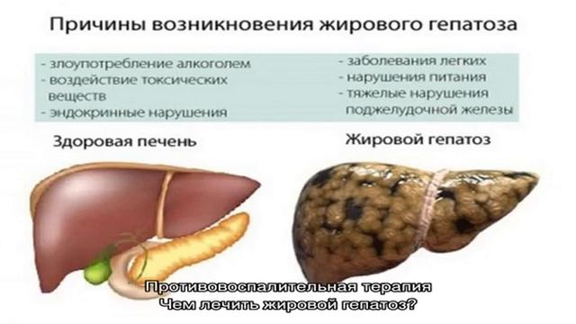 Лечение жирового гепатоза печени