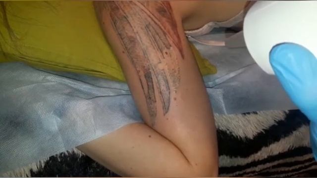 Лазерное удаление татуировок