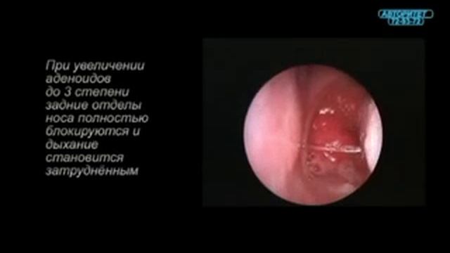эндоскопия носоглоткистепени аденоидов)