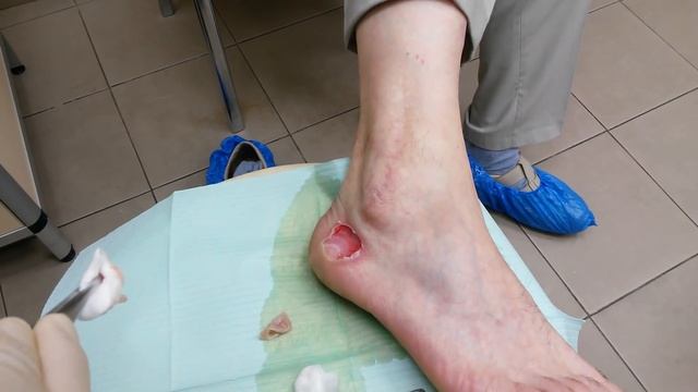 Обработка ожога 2 степени