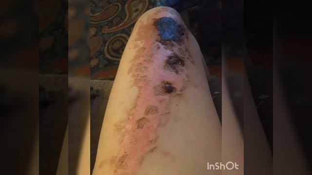 Как заживает ожог