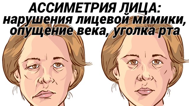 Нарушения лицевой мимики: опущение века, уголка рта, асимметрия лица - причины, симптомы, лечение!