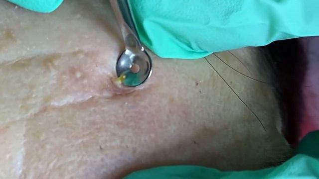 粉刺 粟粒腫 Самое залипательное видео давить прыщи Черные точки Dermatologist video to press pimples