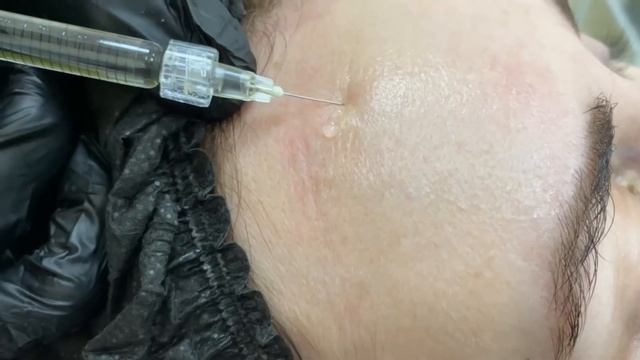 БЛАНШИРОВАНИЕ МОРЩИН ЗОНЫ ЛБА