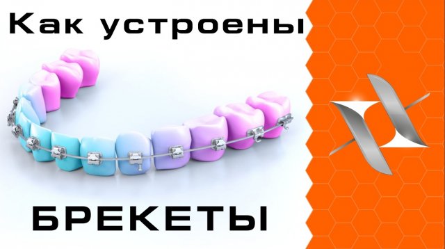 КАК РАБОТАЮТ БРЕКЕТЫ. Устройство брекет-системы.