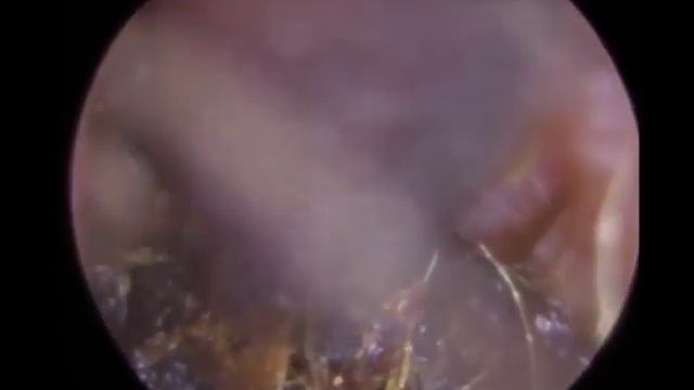 Извлечение огромного куска ушной серы из уха | Часть 1