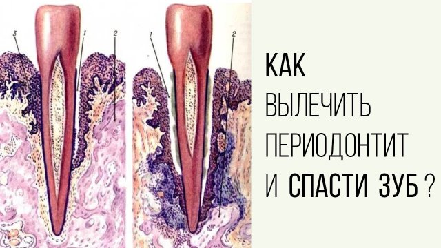 Как вылечить периодонтит и спасти зуб❓