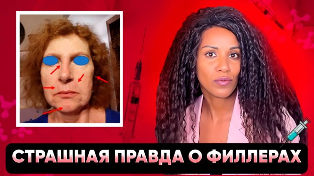 Новое аутоиммунное заболевание, вызываемое филлерами // ASIA-синдром // Чем опасна гиалуронка?