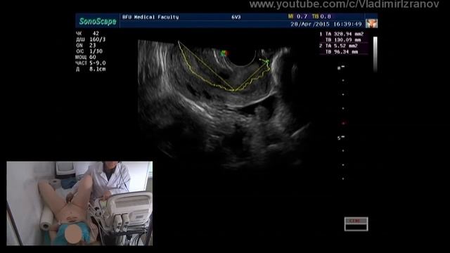 Практическое занятие: УЗИ органов малого таза у женщин (пациентка 1)