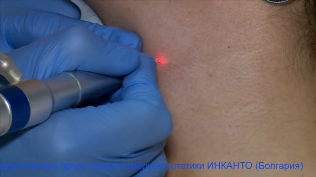 Удаление новообразований кожи с помощью CO₂ лазера