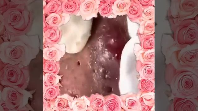 Pimple & Blackheads Popping - 25