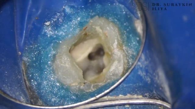 Немного эндодонтического лечения , лечение и пломбировка корневых каналов зуба , удаление нерва