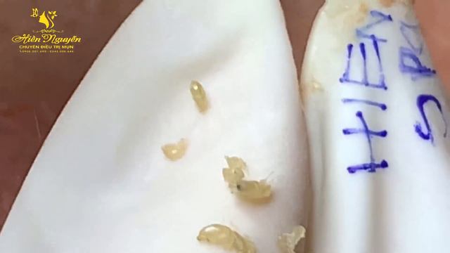 Satisfying Hien Spa Beauty Relaxing Video #12