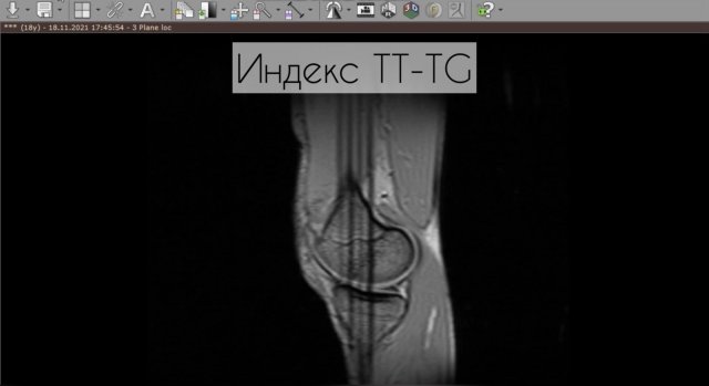 Индекс TT-TG по МРТ