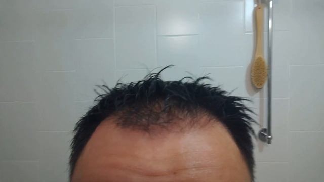 Микронидлинг & эфирные масла против выпадения волос / Microneedling & essential oils Anti Hair Los