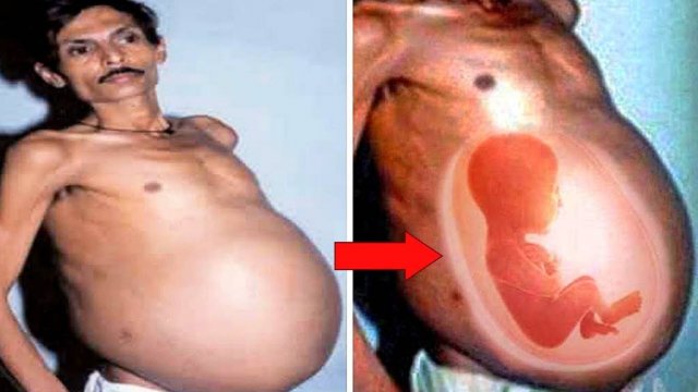 Откуда у Мужчины ребенок в животе? Самые безумные вещи, обнаруженные в человеческом теле!