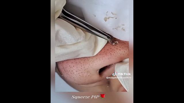 Акне прыщи на лице, коже- выдавливание прыщей акне #acne