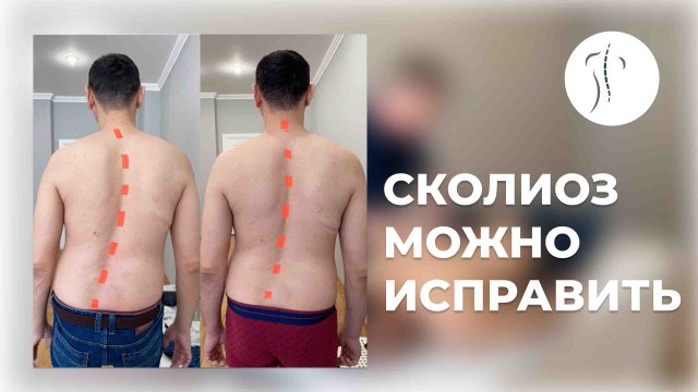 Сколиоз можно исправить | Костоправ Саксин Алексей