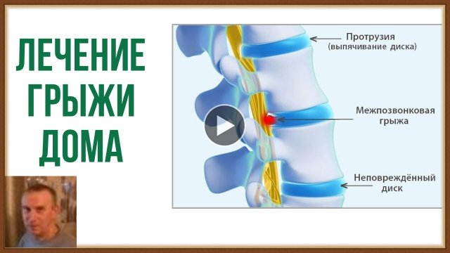 ЛЕЧЕНИЕ ГРЫЖИ ПОЗВОНОЧНИКА ДОМА