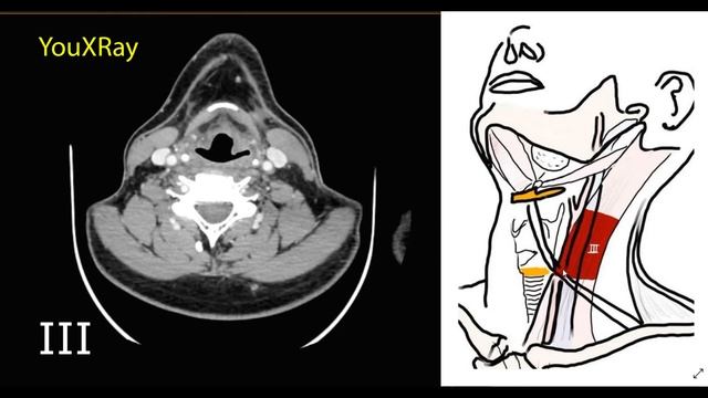 Уровни лимфоузлов шеи на КТ    |Лучевая диагностика|