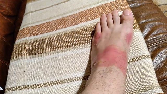 Чем лечить ожоги (кипятком) 1 и 2 степени (волдыри) Первые меры Рецепт и мой опыт