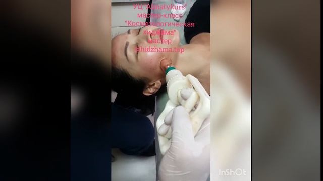 Хиджама на лицо или косметологическая хиджама