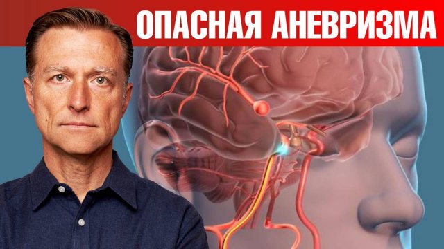 Боитесь инсульта? Бойтесь АНЕВРИЗМЫ. ☠ Причины аневризмы.
