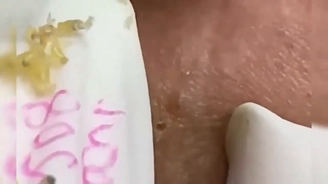 ? Огромные Черные Точки//black heads removed