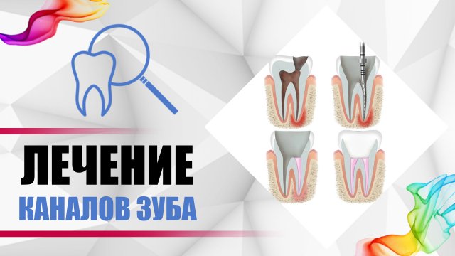 Каналы зубов - лечение в 5 этапов. Удаление нерва из зуба, лечение #пульпита без боли в стоматологии