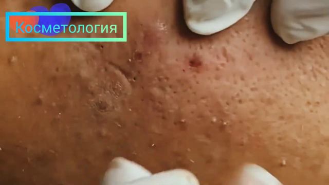 Прыщи на лице - acne on the face