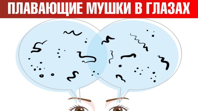 Как избавиться от мушек в глазах? Мушки перед глазами: причины🧐