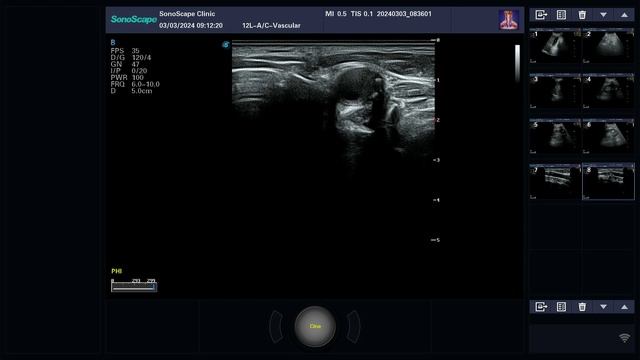 Стеноз внутренней сонной артерии 75% по ПЛОЩАДИ