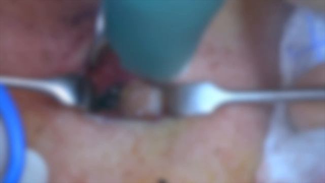 Tracheostomy