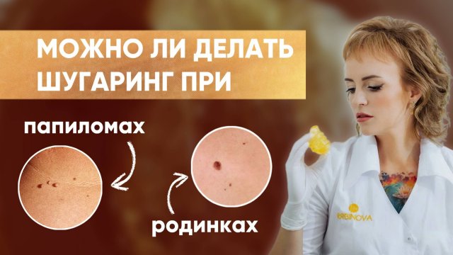 ШУГАРИНГ И ПАПИЛОМЫ | Особенности кожи | Папилломы, кондиломы и родинки - противопоказания?