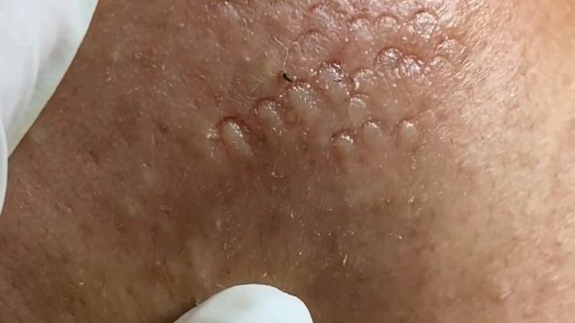Acne removal pimple popper blackheads and whiteheads at Clinic part 3 with TheMun milia