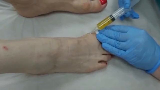 Лечение полинейропатии