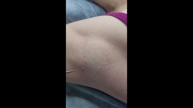 Процесс удаления папилом электрокоагуляцией от и до