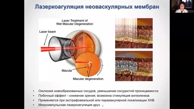 Заболевания сетчатки, осложненные ХНВ