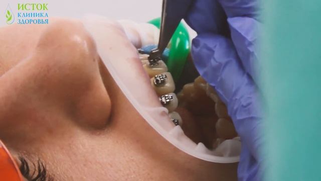 ЗАЧЕМ НУЖНЫ БРЕКЕТЫ? Клиника Здоровья Исток