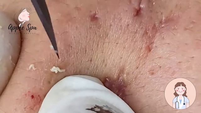 Relax every day with Apple Spa - Squeeze acne blackheads #47