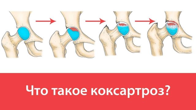 Что такое коксартроз тазобедренного сустава?