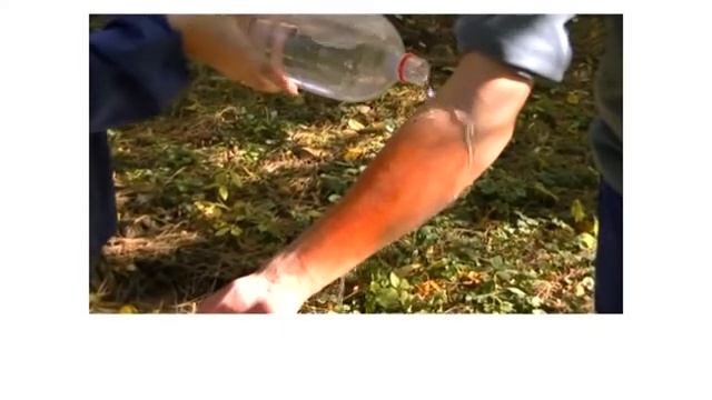 Первая помощь при ожогах