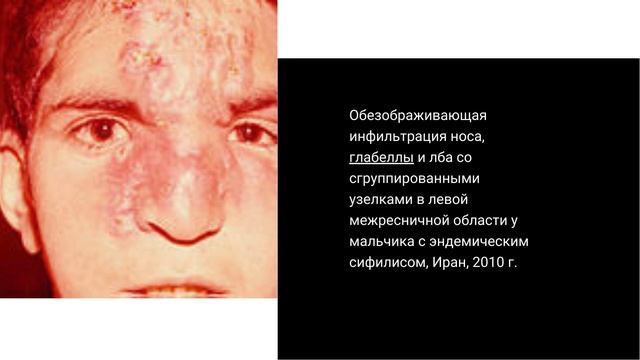 Спирохеты