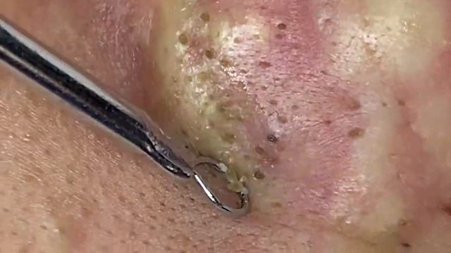 ACNE CLEANING RELAX - KINISH TV #54
