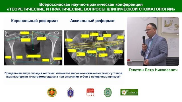 Гелетин П.Н. Планирование комплексной реабилитации пациентов с нарушениями внчс и жевательных мышц