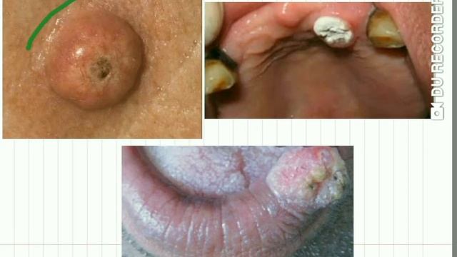 Keratoacanthoma