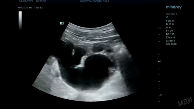 Гидронефроз