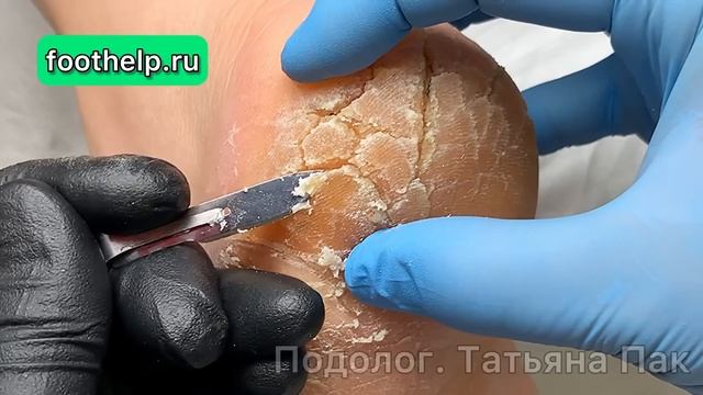 Пятки до состояния потрескавшейся земли. Колонии грибов в условиях влажной среды #подологтатьянапак