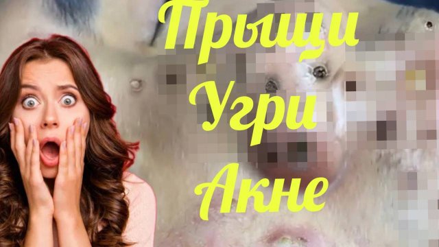 42 МЛН. просмотров за НЕДЕЛЮ. Обзор на работу КОСМЕТОЛОГА. Давим АКНЕ ПРЫЩИ и ГНОЙНИКИ